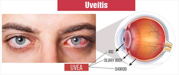 UVEITIS : PENANGANAN DAN PENGOBATAN